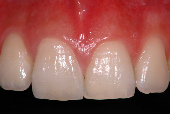 セラミックの歯科技工