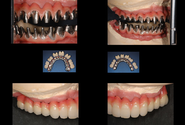 インプラント歯科技工
